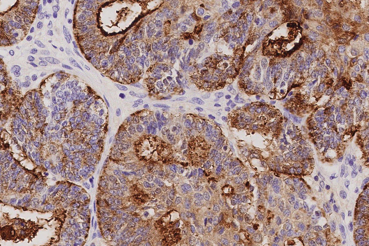 CA125 (Ovarian Cancer Antigen) 製品画像 Front View L
